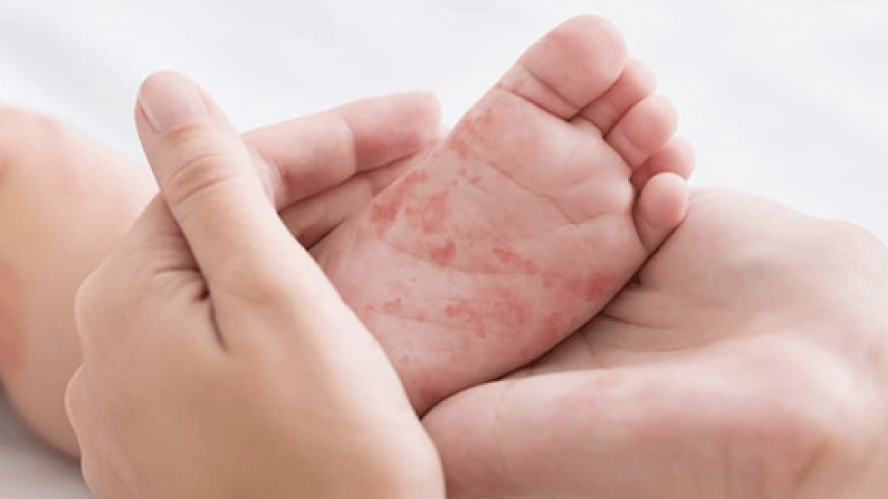 Foto - Kızamıkta aşı karşıtlığı uyarısı! Uzman isim tek tek açıkladı.. Mutlaka not edin!