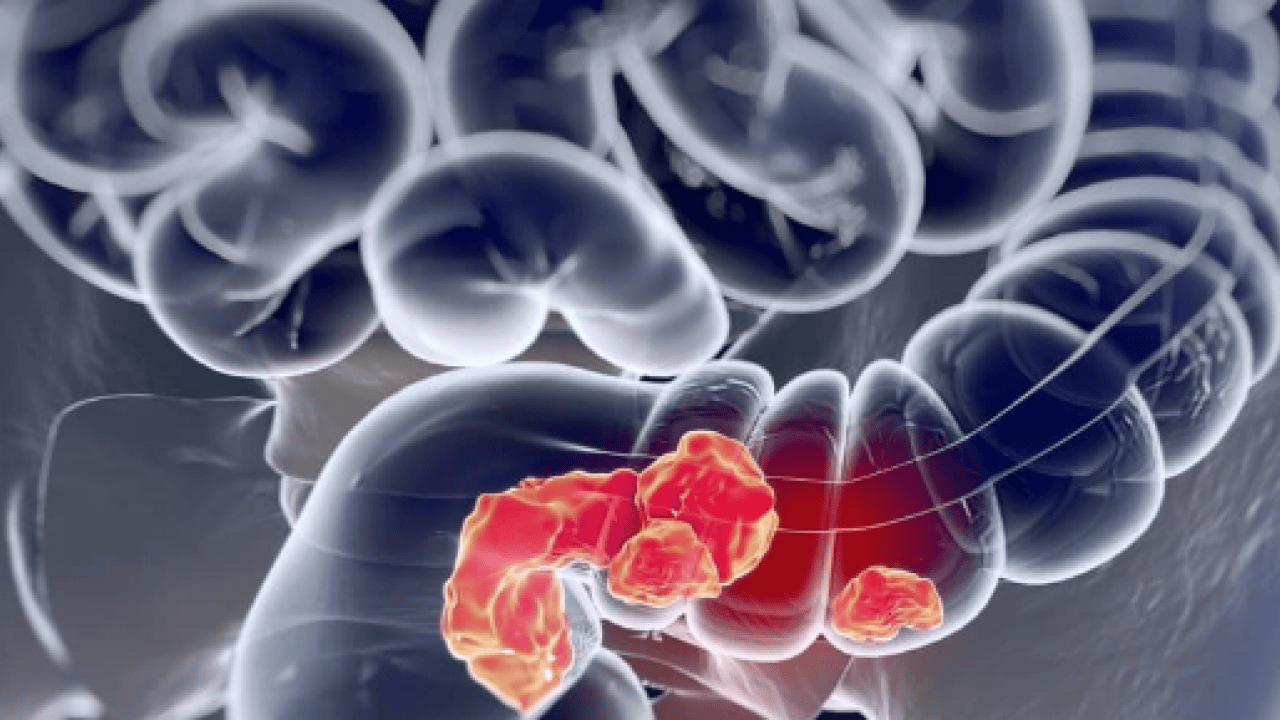 Foto - Kolorektal kanser uyarısı: Sağlık Bakanlığı uyardı: Her yıl yaklaşık 1,9 milyon yeni vaka...