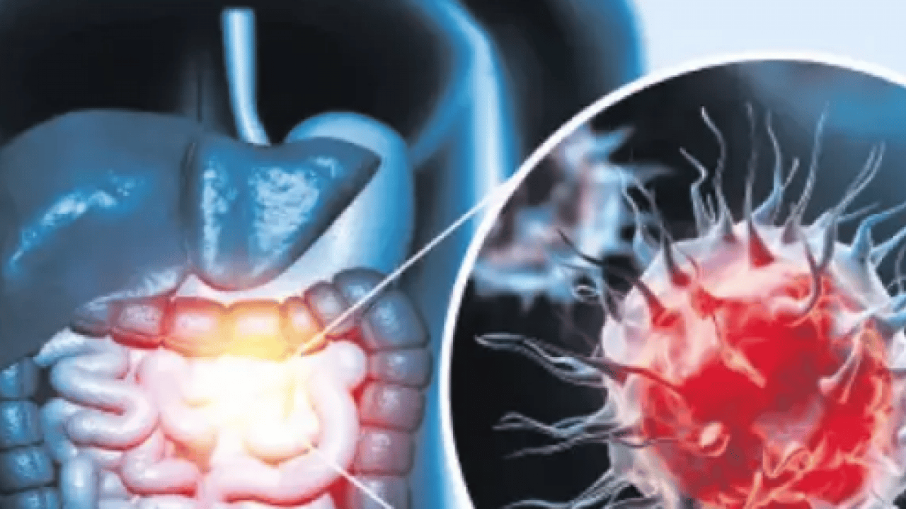 Foto - Kolorektal kanser uyarısı: Sağlık Bakanlığı uyardı: Her yıl yaklaşık 1,9 milyon yeni vaka...