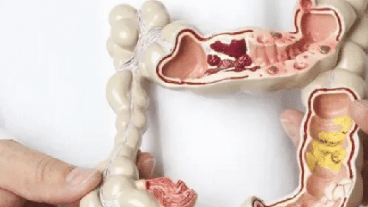 Foto - Kolorektal kanser uyarısı: Sağlık Bakanlığı uyardı: Her yıl yaklaşık 1,9 milyon yeni vaka...