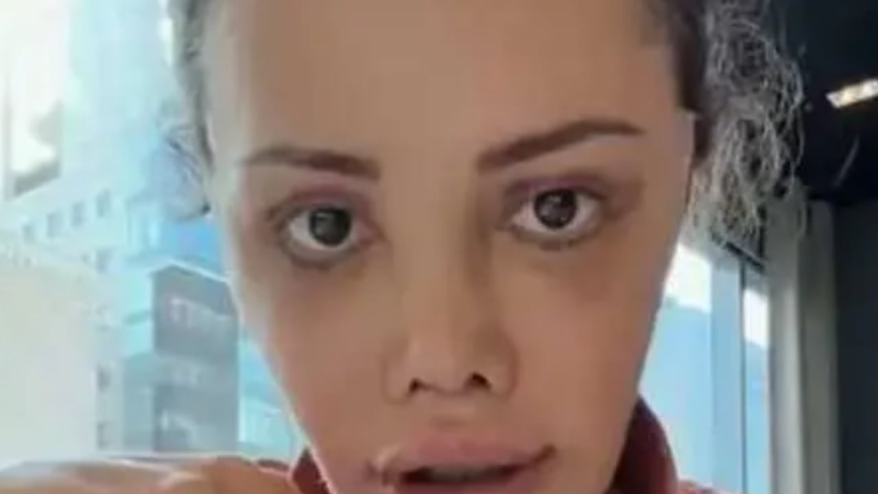 Foto - Kore'de estetik oldu diye başına gelmeyen kalmadı! Ölüm mesajları alıyor!