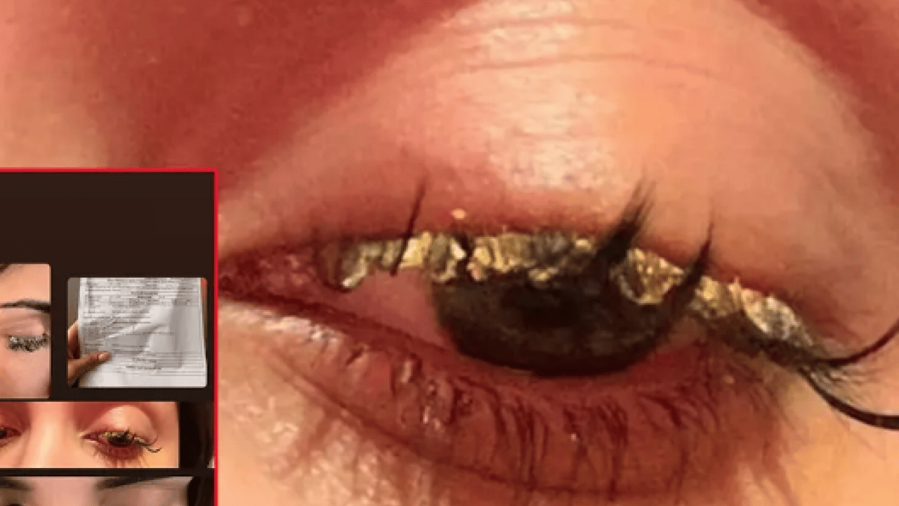 Foto - Korkunç olay: Kirpiklerini yaptırmaya gitti ama gözlerini yaktı... Kör olabilirdim! Görenleri şaşkına çevirdi