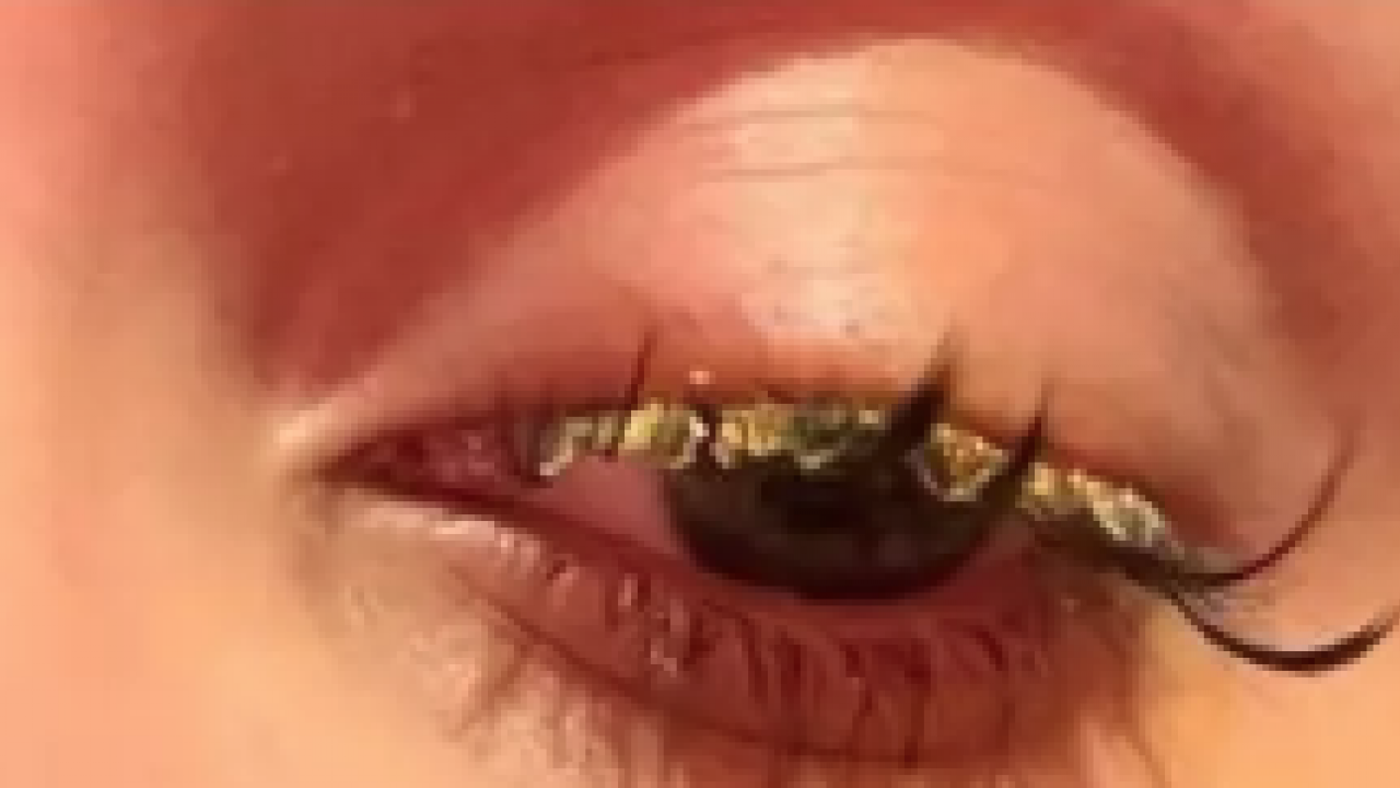 Korkunç olay: Kirpiklerini yaptırmaya gitti ama gözlerini yaktı... Kör olabilirdim! Görenleri şaşkına çevirdi