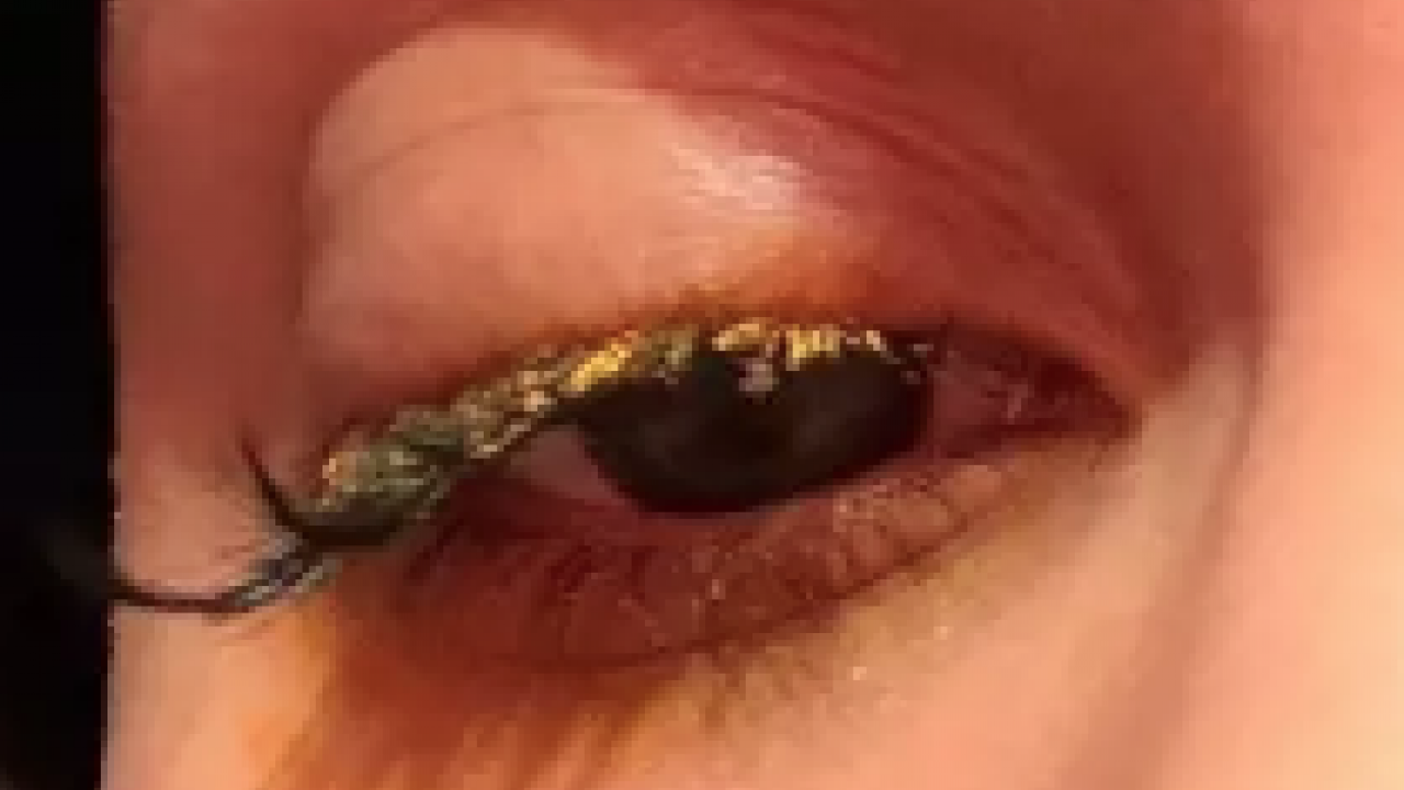 Foto - Korkunç olay: Kirpiklerini yaptırmaya gitti ama gözlerini yaktı... Kör olabilirdim! Görenleri şaşkına çevirdi