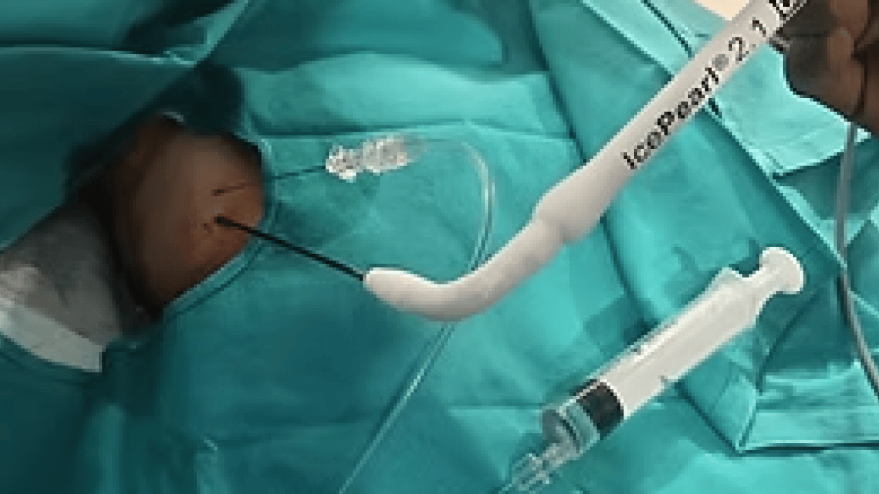 -20 ile -80 derece arasında değişen bir soğukluk... Kriyoablasyon cerrahiye uygun olmayan...