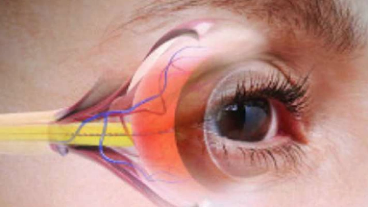Lazer ya da cerrahi tedavi... Göz tansiyonunda erken tanı körlüğün önüne geçiyor