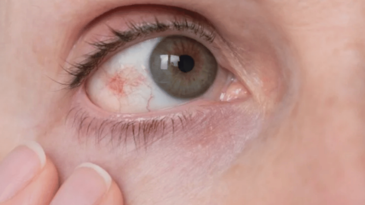 Foto - Lazer ya da cerrahi tedavi... Göz tansiyonunda erken tanı körlüğün önüne geçiyor