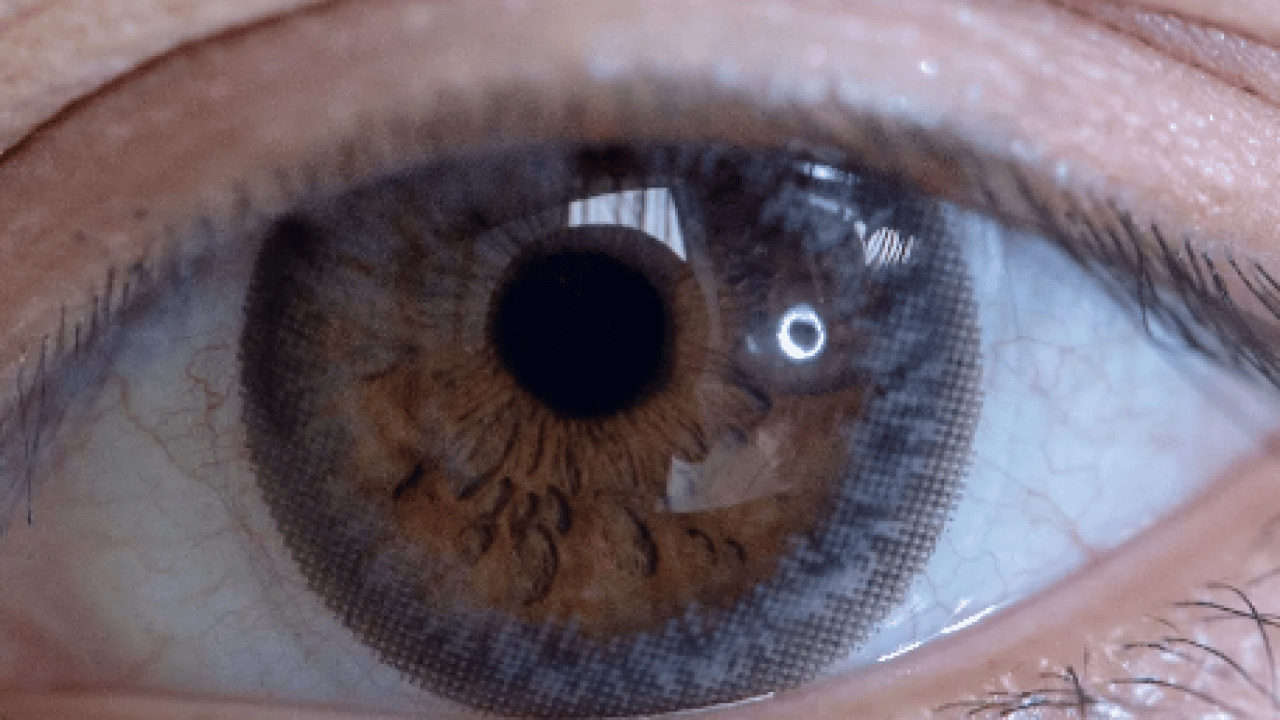 Foto - Lazer ya da cerrahi tedavi... Göz tansiyonunda erken tanı körlüğün önüne geçiyor