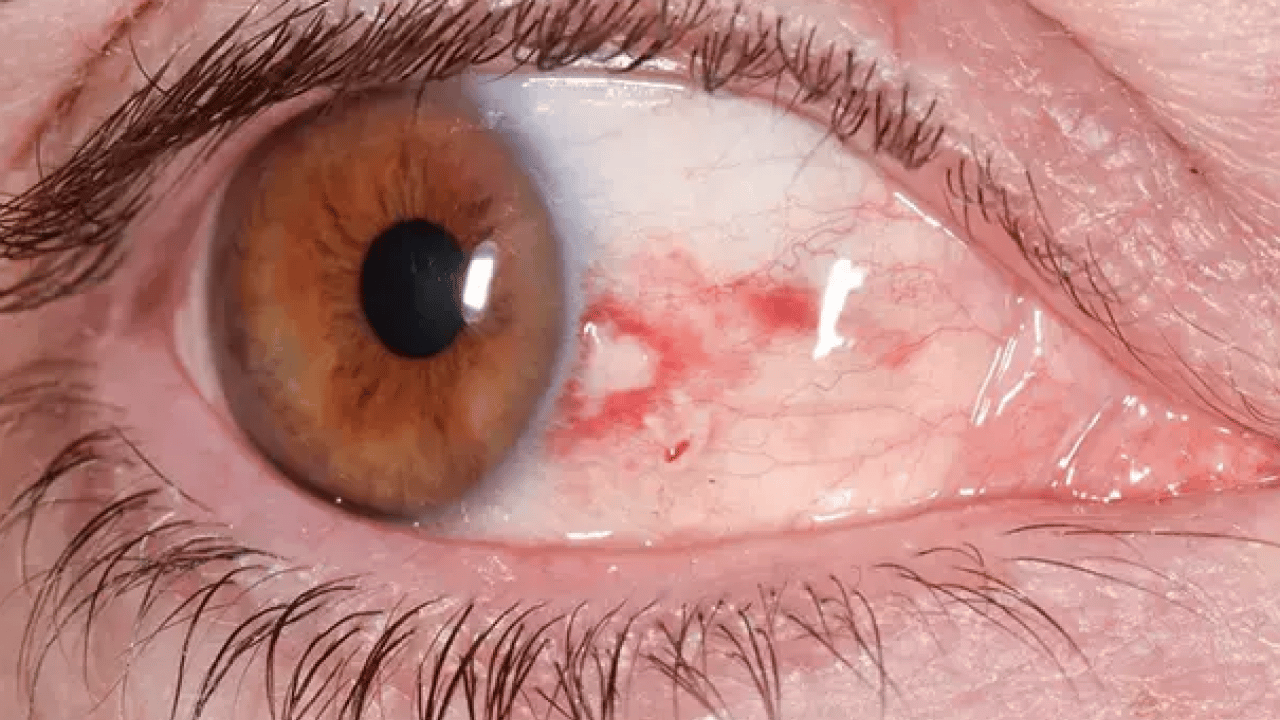 Foto - Lazer ya da cerrahi tedavi... Göz tansiyonunda erken tanı körlüğün önüne geçiyor