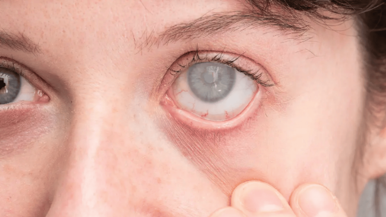 Foto - Lazer ya da cerrahi tedavi... Göz tansiyonunda erken tanı körlüğün önüne geçiyor