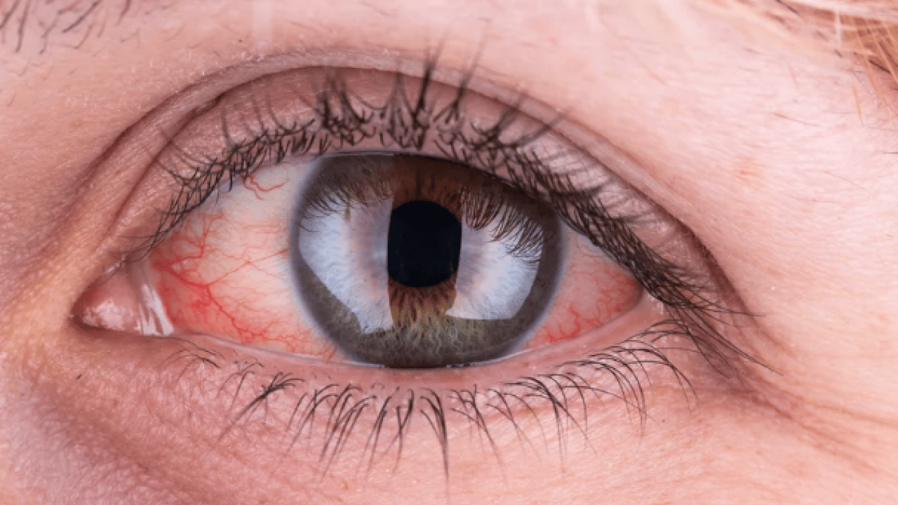 Foto - Lazer ya da cerrahi tedavi... Göz tansiyonunda erken tanı körlüğün önüne geçiyor