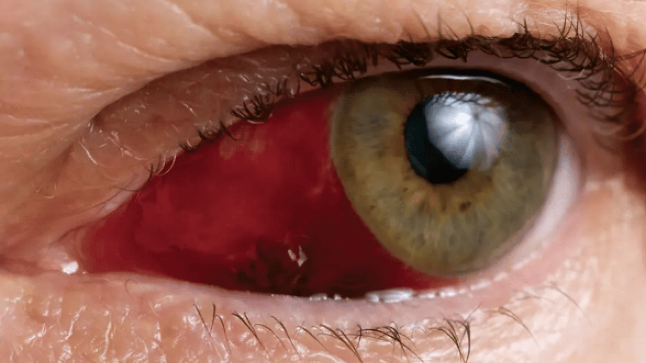 Foto - Lazer ya da cerrahi tedavi... Göz tansiyonunda erken tanı körlüğün önüne geçiyor