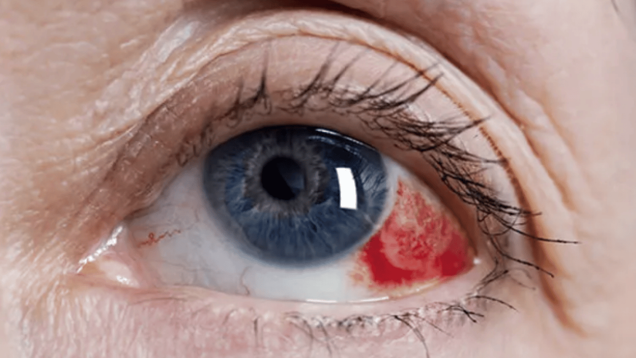 Foto - Lazer ya da cerrahi tedavi... Göz tansiyonunda erken tanı körlüğün önüne geçiyor