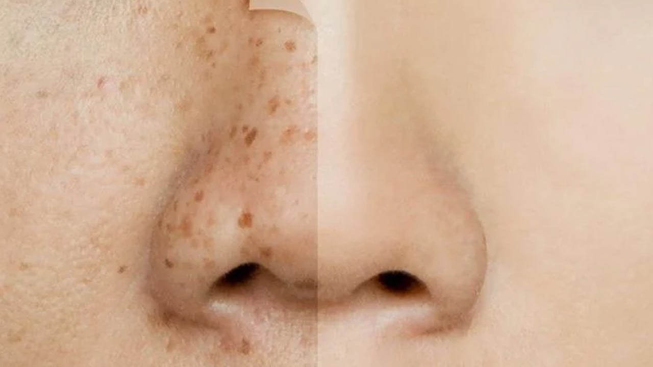 Foto - Leke silme formülü: Ciltten lekeler nasıl çıkarılır?