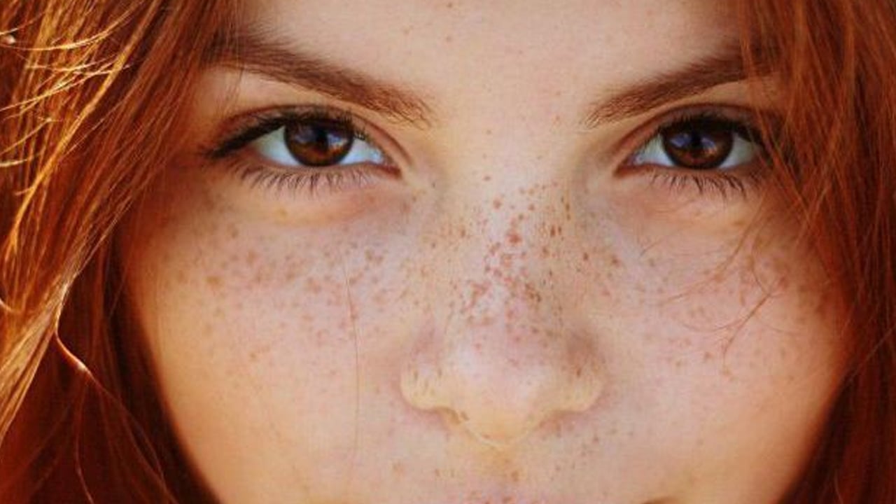 Foto - Leke silme formülü: Ciltten lekeler nasıl çıkarılır?