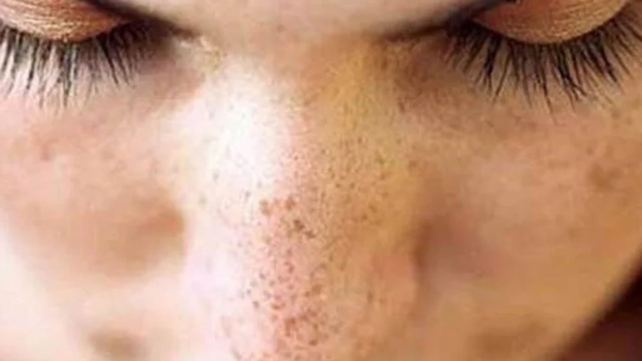 Leke silme formülü: Ciltten lekeler nasıl çıkarılır?