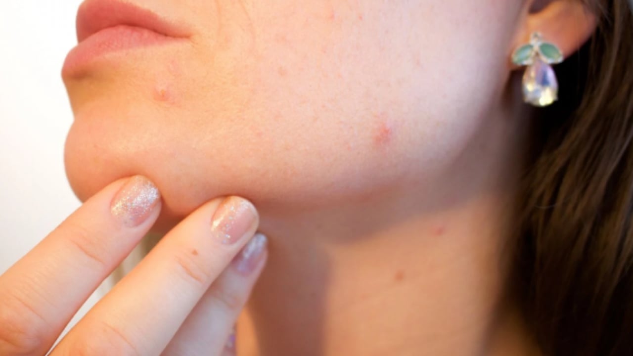 Foto - Maske ve krem devri kapanıyor! Yüzünüzde çıkan sivilcelerden kurtulmanın doğal yolu