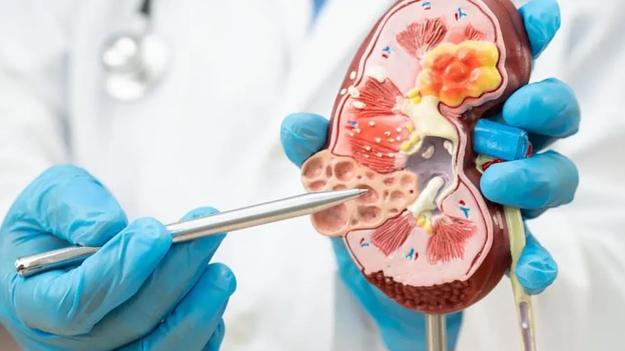 Foto - Melih Kara: Böbrek üstüne ait bezde tehlike olabilir! Mide bulantısı gibi çok sayıda belirti var diyerek duyurdu