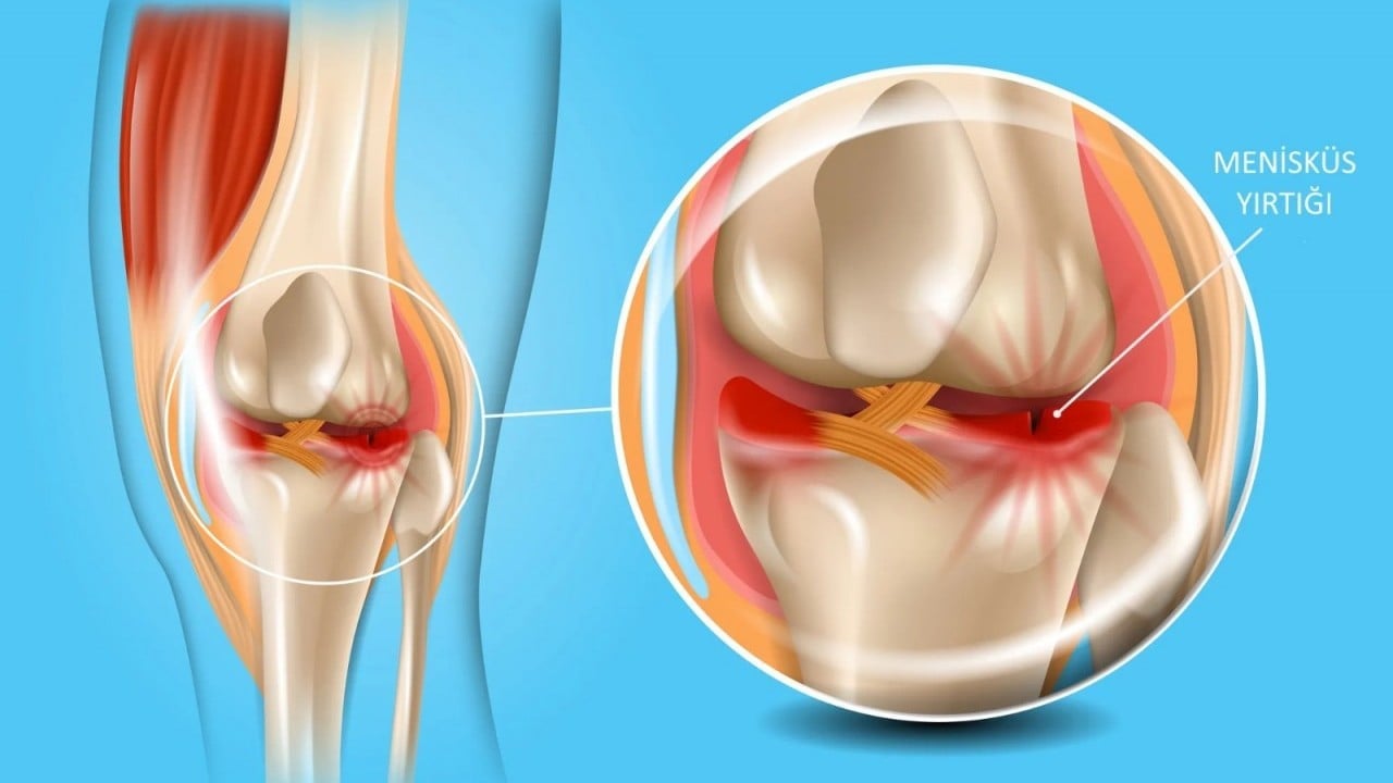 Foto - Menisküs yırtıldığında mutlaka ameliyat olunmalı mı? Uzmanlardan uyarı geldi!