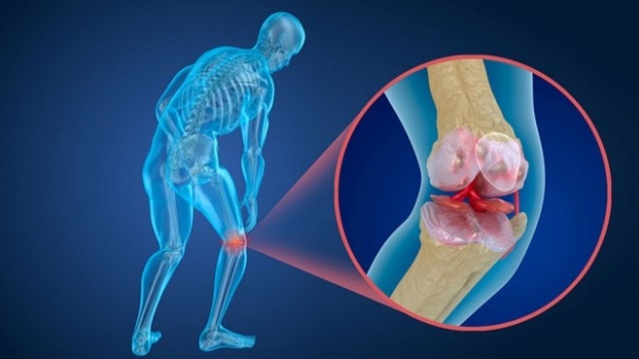Menisküs yırtıldığında mutlaka ameliyat olunmalı mı? Uzmanlardan uyarı geldi!