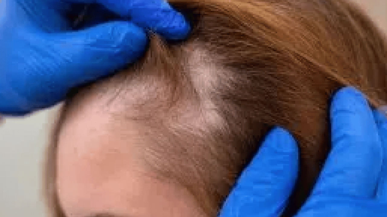 Foto - Mevsim geçişleri, stres ve yanlış bakım: Saç dökülmesini durduran maske tarifi! Reçete verildi...