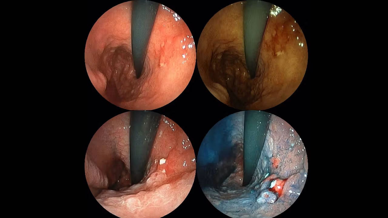 Foto - Mide kanseri sessiz İlerliyor: Sıcak yiyenler sessizce geliyor! Prof. Dr. Yavuz Selim çağrı yaptı