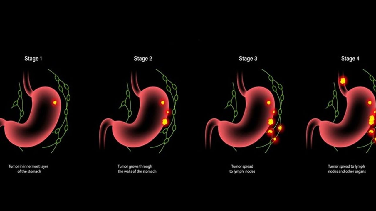  Mide kanseri sessiz İlerliyor: Sıcak yiyenler sessizce geliyor! Prof. Dr. Yavuz Selim çağrı yaptı