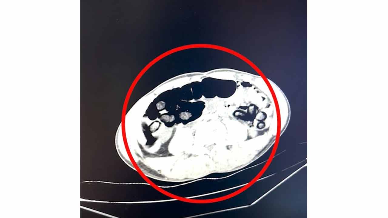 Midelerinden çıkanlar şoka soktu! Tam 353 parça....