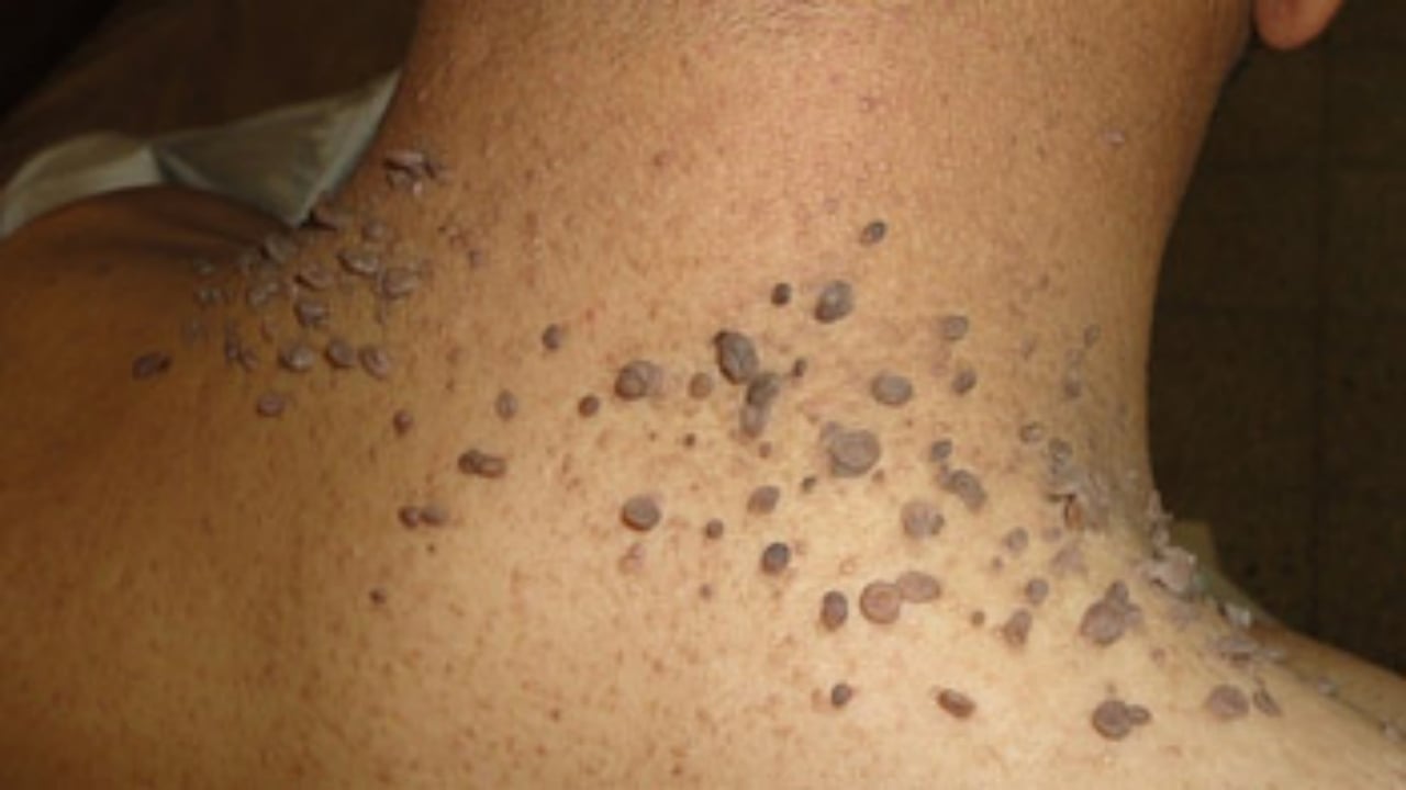 Foto - Milyonların derdi şak diye bitiyor! Mutfaktaki tek malzemeyle et benlerinden kurtulabilirsiniz