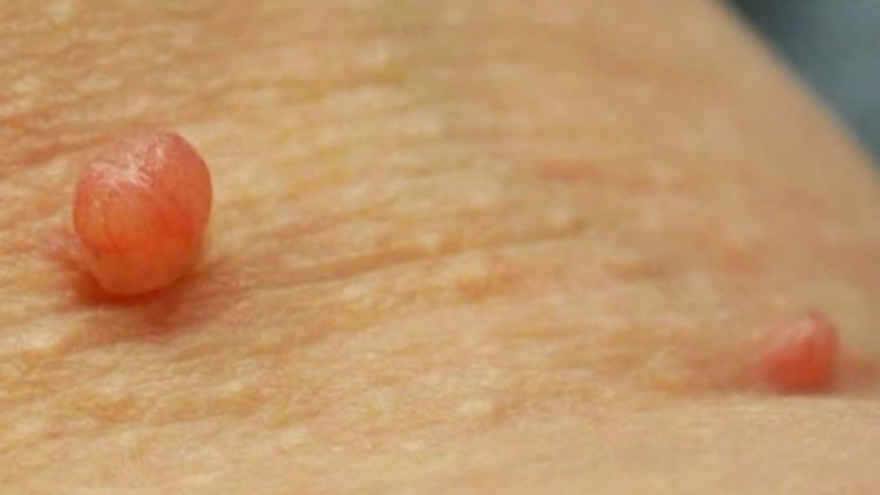 Foto - Milyonların derdi şak diye bitiyor! Mutfaktaki tek malzemeyle et benlerinden kurtulabilirsiniz