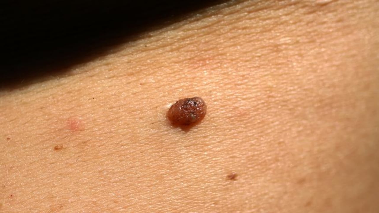 Milyonların derdi şak diye bitiyor! Mutfaktaki tek malzemeyle et benlerinden kurtulabilirsiniz