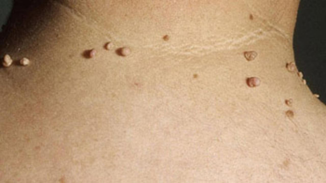 Foto - Milyonların derdi şak diye bitiyor! Mutfaktaki tek malzemeyle et benlerinden kurtulabilirsiniz