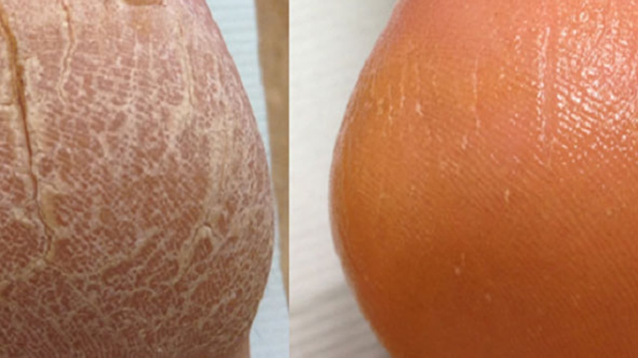 Foto - Mutfaktaki iki malzeme ile topuk çatlaklarından kurtulun: Topuk çatlaklarına ne iyi gelir? Mutfağın görünmez kahramanları!