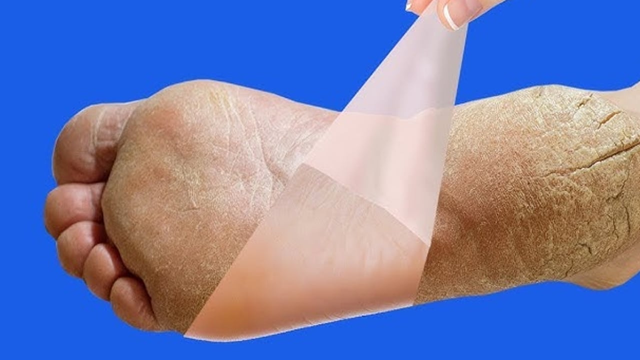 Mutfaktaki iki malzeme ile topuk çatlaklarından kurtulun: Topuk çatlaklarına ne iyi gelir? Mutfağın görünmez kahramanları!