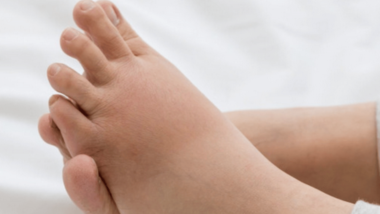 Nadir görülen herediter anjioödem hastalığı tedavi edilmezse ölümcül olabilir! Prof. Dr. duyurdu...