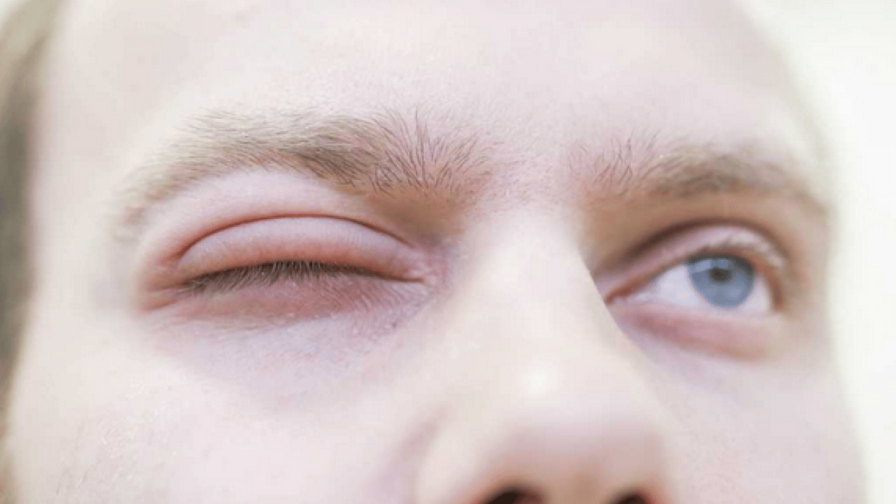 Foto - Nadir görülen herediter anjioödem hastalığı tedavi edilmezse ölümcül olabilir! Prof. Dr. duyurdu...