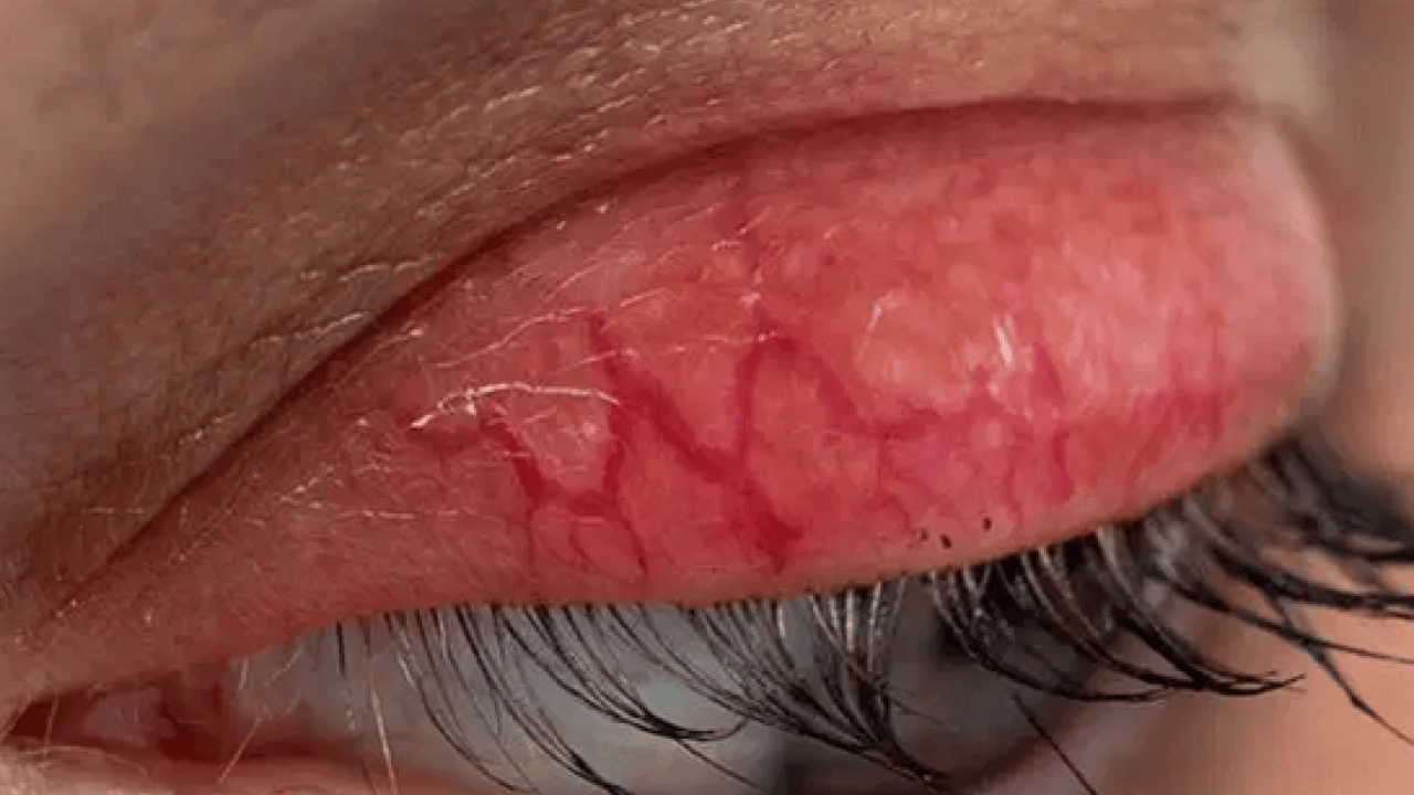 Foto - Nadir görülen herediter anjioödem hastalığı tedavi edilmezse ölümcül olabilir! Prof. Dr. duyurdu...