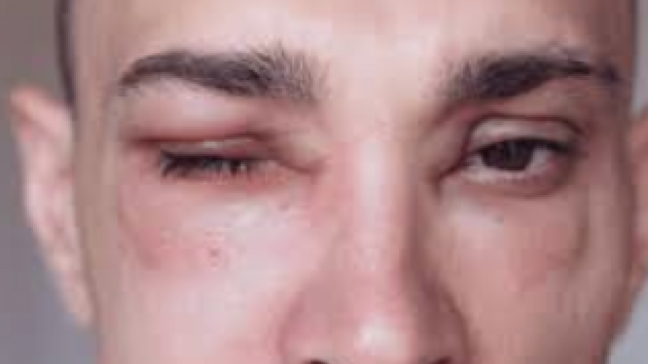 Foto - Nadir görülen herediter anjioödem hastalığı tedavi edilmezse ölümcül olabilir! Prof. Dr. duyurdu...