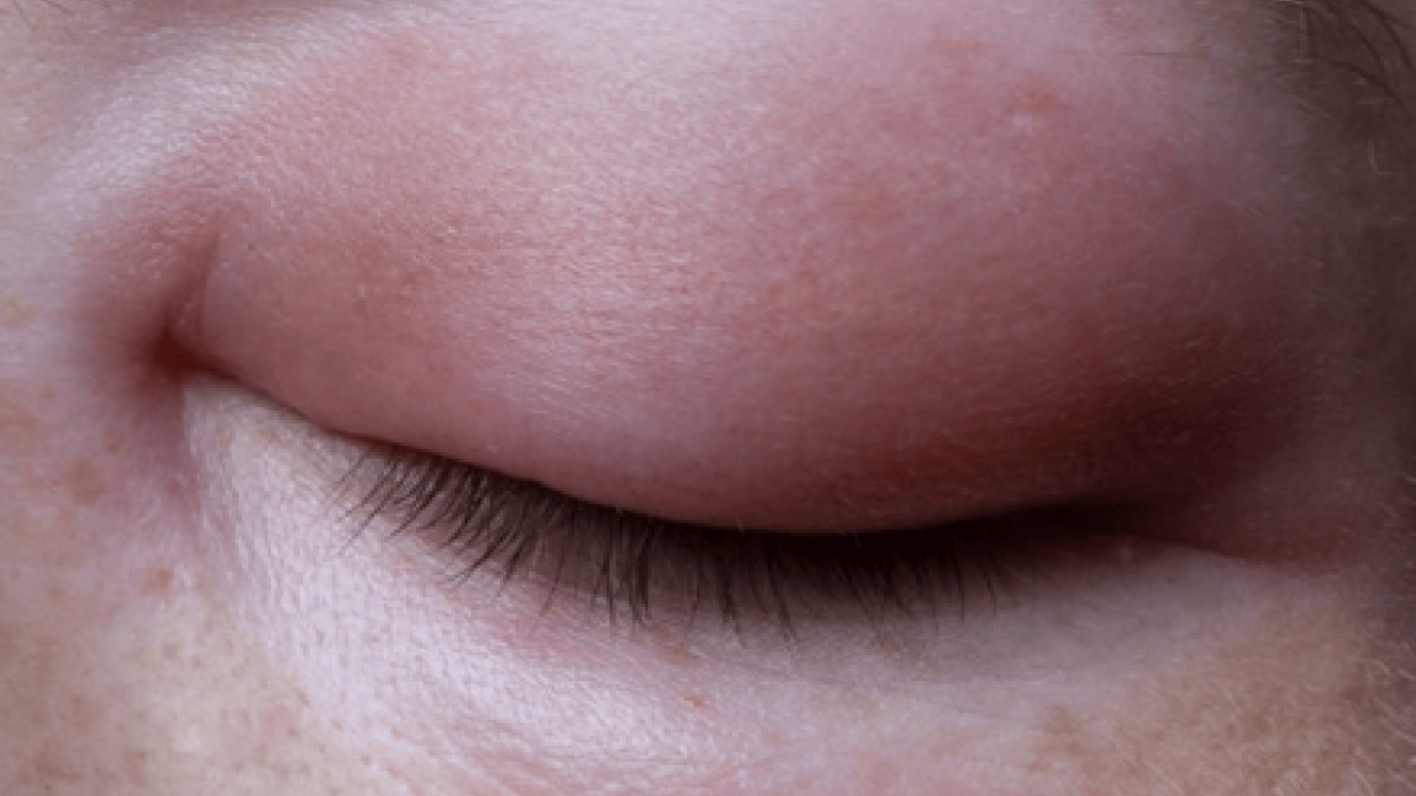 Foto - Nadir görülen herediter anjioödem hastalığı tedavi edilmezse ölümcül olabilir! Prof. Dr. duyurdu...