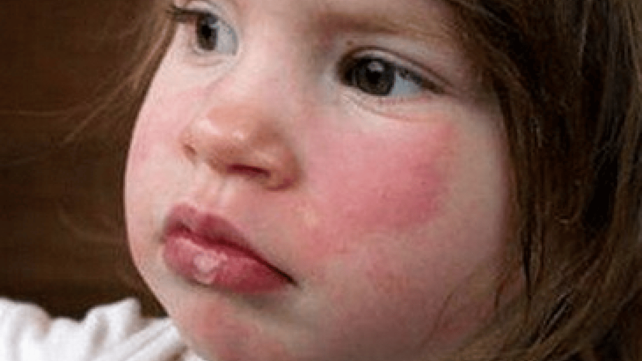 Foto - Nadir görülen herediter anjioödem hastalığı tedavi edilmezse ölümcül olabilir! Prof. Dr. duyurdu...