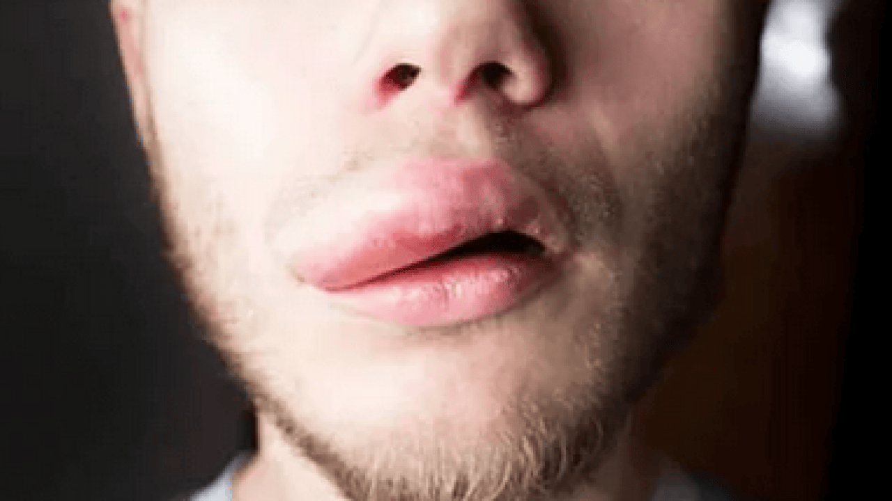 Foto - Nadir görülen herediter anjioödem hastalığı tedavi edilmezse ölümcül olabilir! Prof. Dr. duyurdu...