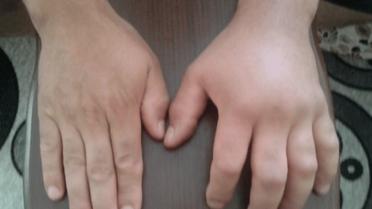 Foto - Nadir görülen herediter anjioödem hastalığı tedavi edilmezse ölümcül olabilir! Prof. Dr. duyurdu...