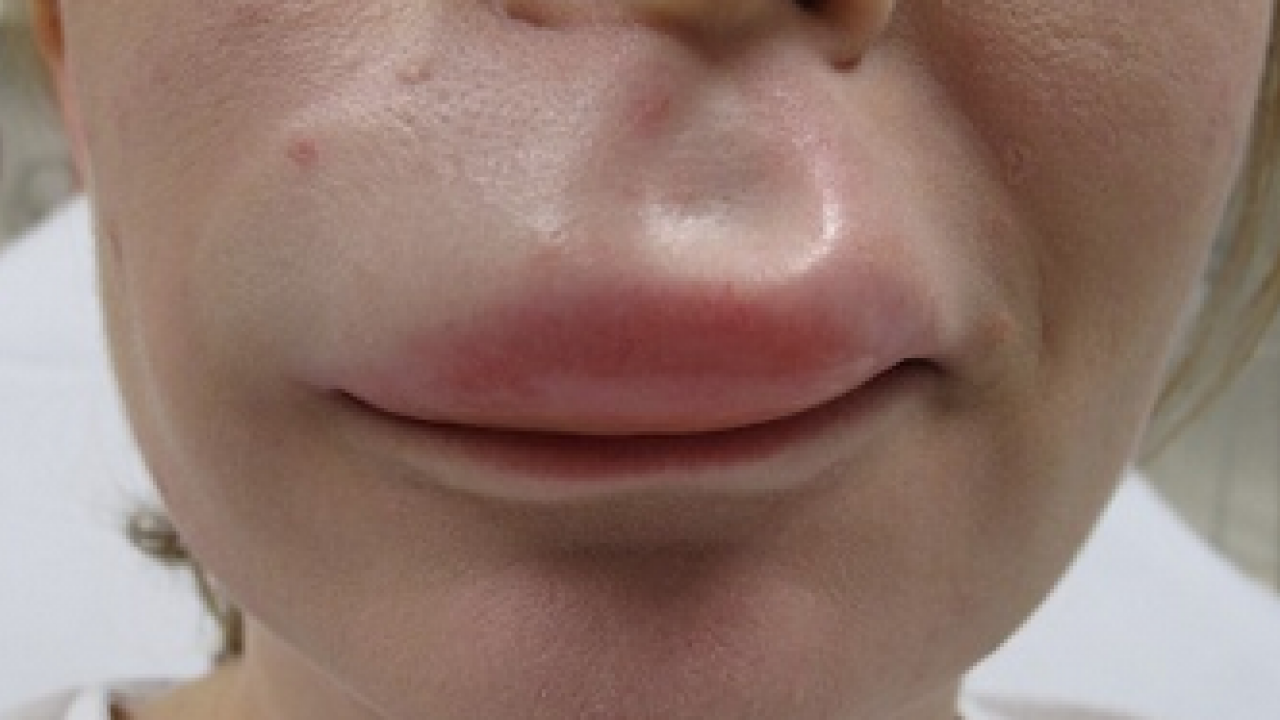 Foto - Nadir görülen herediter anjioödem hastalığı tedavi edilmezse ölümcül olabilir! Prof. Dr. duyurdu...