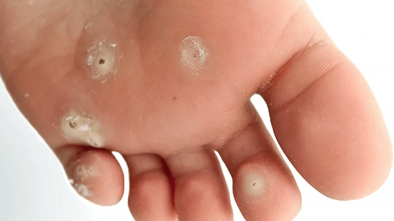 Foto - Nasır için tedavi yöntemleri: Ayaklardaki nasır problemini çözen yöntem! İlk dikkat edilmesi gerekenler! Uzak durun