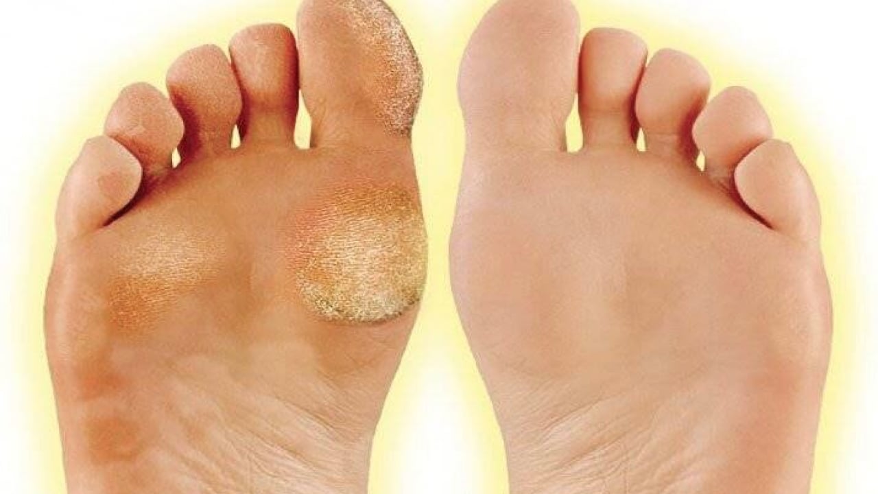 Foto - Nasır için tedavi yöntemleri: Ayaklardaki nasır problemini çözen yöntem! İlk dikkat edilmesi gerekenler! Uzak durun