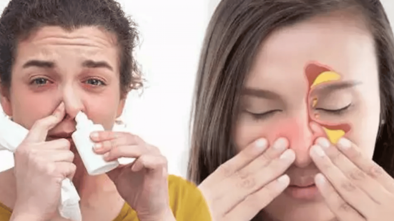 Foto - Nazal Polip olabilir korkusu! Uzun süren burun tıkanıklığı...