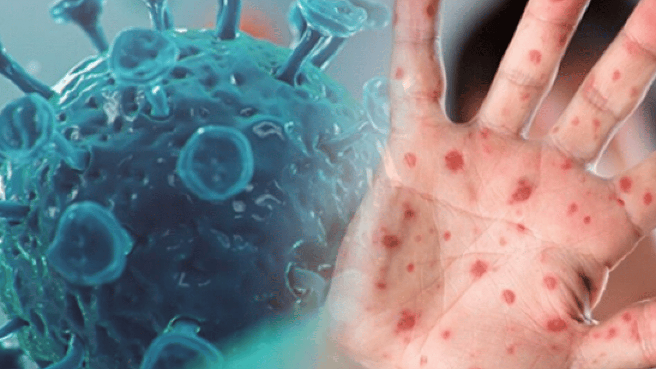 Foto - Neler oluyor böyle? M Çiçeği Virüsü Yayılıyor: Tüm dünya şaşkın bu işe…