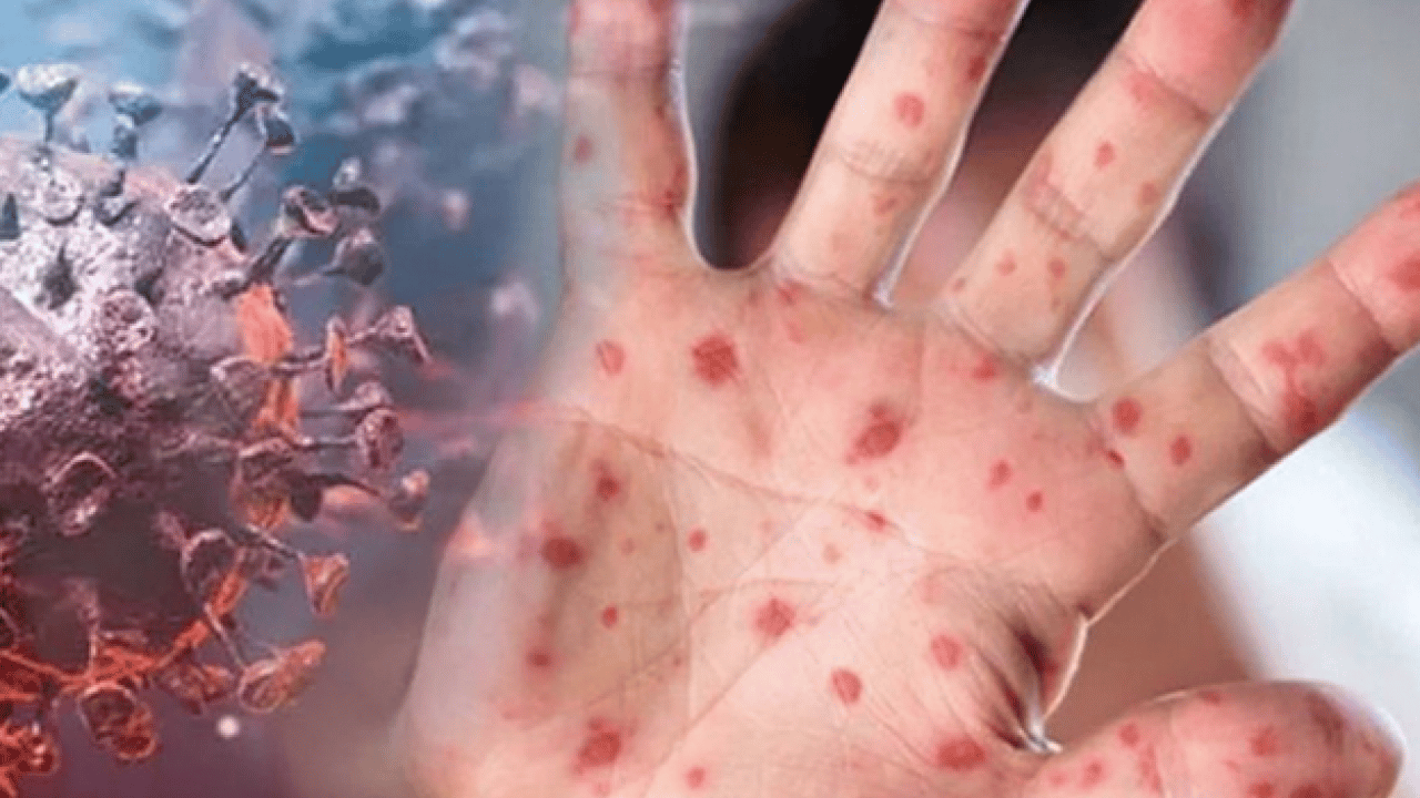 Foto - Neler oluyor böyle? M Çiçeği Virüsü Yayılıyor: Tüm dünya şaşkın bu işe…