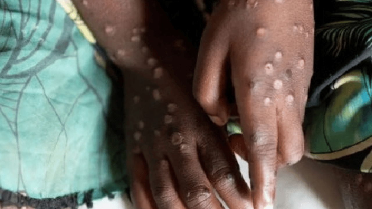 Foto - Neler oluyor böyle? M Çiçeği Virüsü Yayılıyor: Tüm dünya şaşkın bu işe…