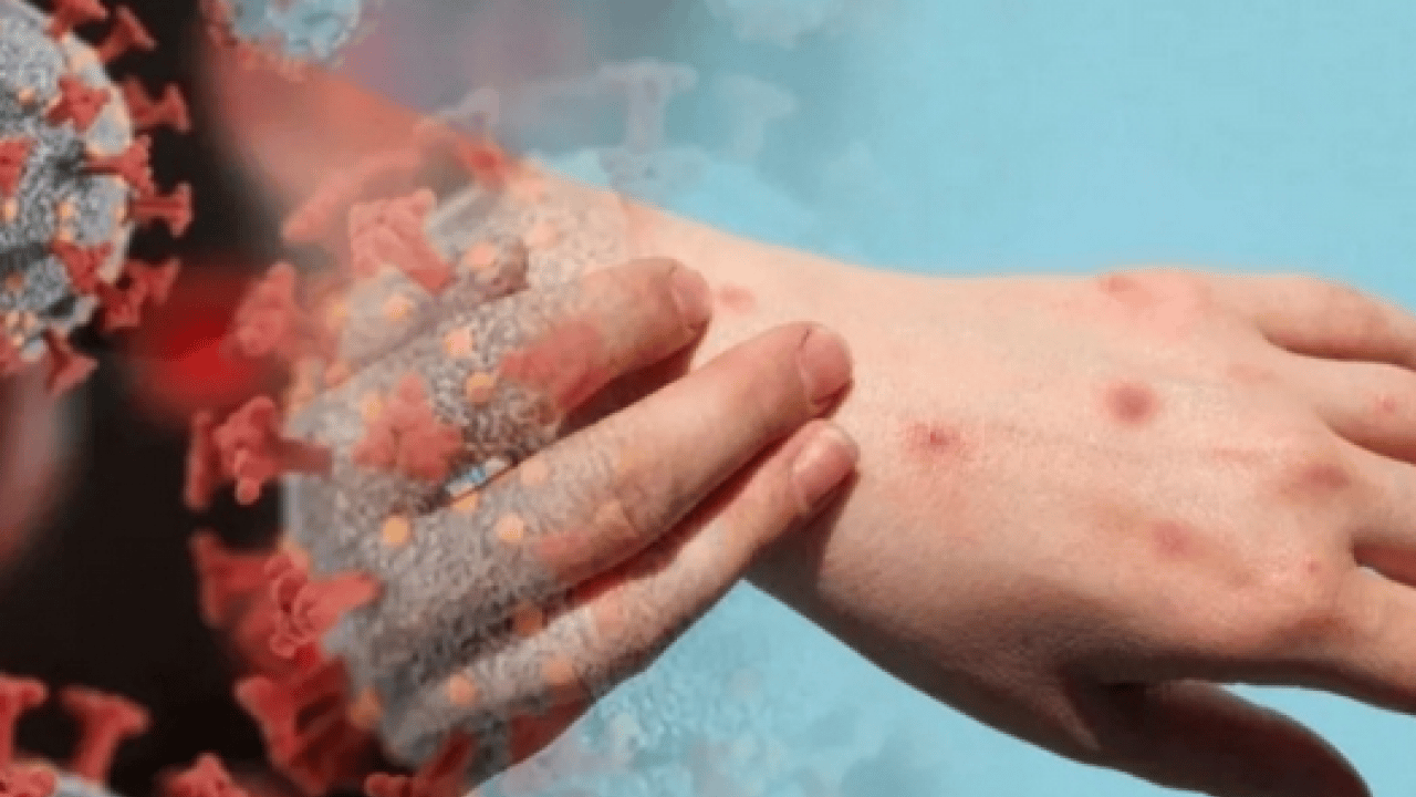 Foto - Neler oluyor böyle? M Çiçeği Virüsü Yayılıyor: Tüm dünya şaşkın bu işe…